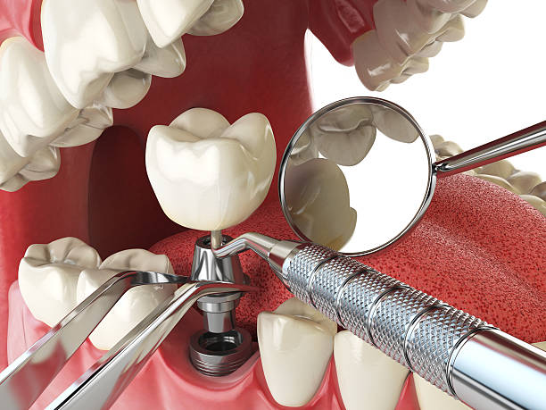 Best Emergency Dentist for Lost Fillings or Crowns in Timberne, LA