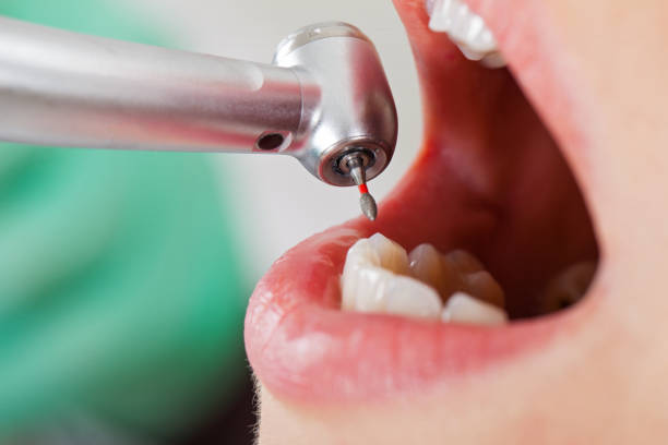 Best Emergency Dentist for Knocked-Out Tooth in Timberne, LA